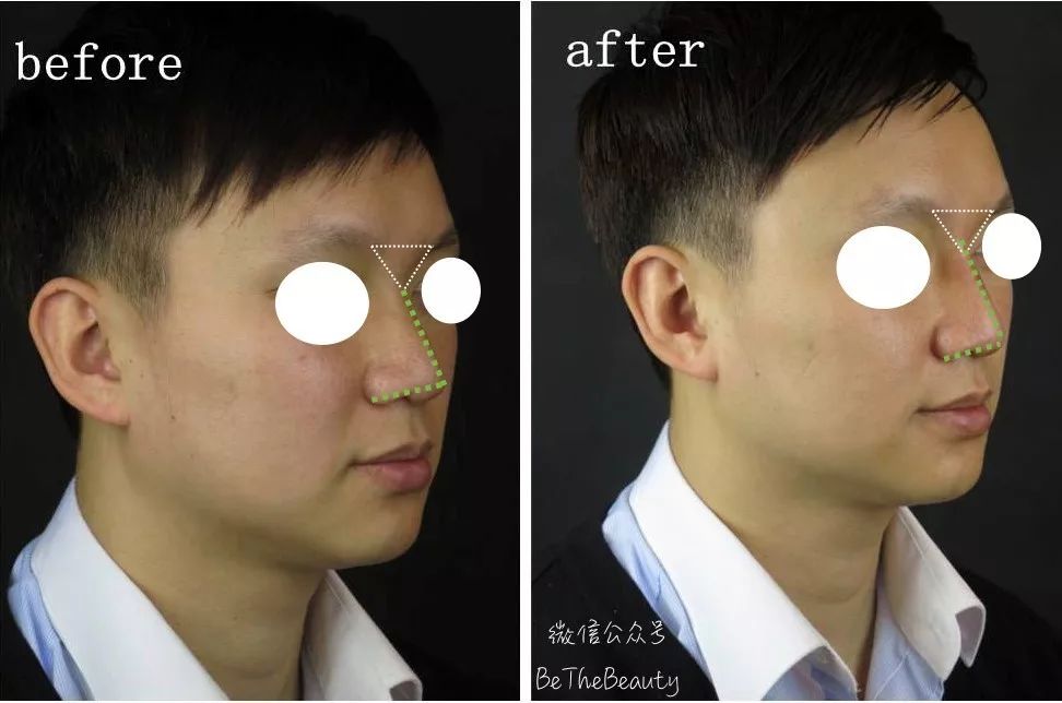 鼻翼宽鼻头大怎么办,塌鼻子鼻翼宽妆容