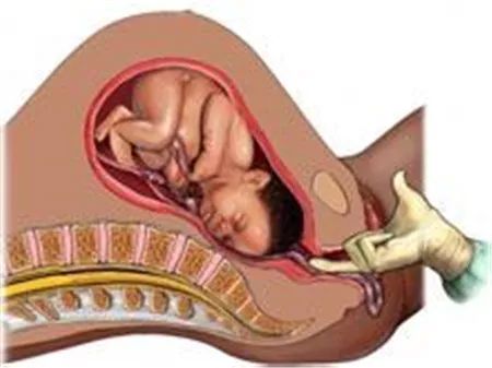 「产科医生日记」脐带脱垂，命悬一线！