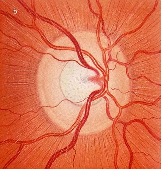 重庆医学界又出大新闻,谁说白内障青光眼不可逆……