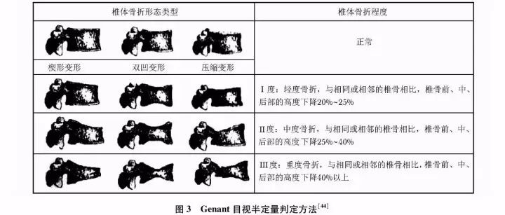 原发性骨质疏松症基层诊疗指南,原发性骨质疏松诊疗指南2018