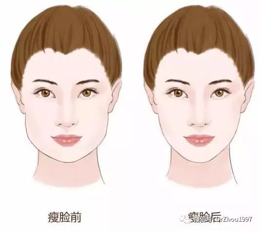 肉毒素矫正大小脸,肉毒素可以改善大小脸吗