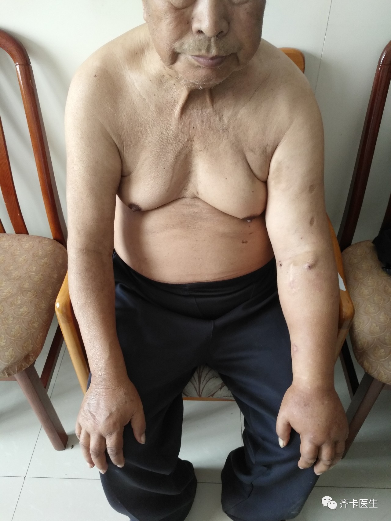 颈部血透导管一般是长期还是临时,颈内静脉临时导管的固定