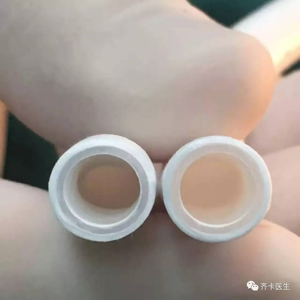 颈部血透导管一般是长期还是临时,颈内静脉临时导管的固定