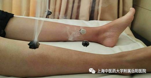 针灸治疗肠易激综合征,针灸治疗腹泻型肠易激综合征优势