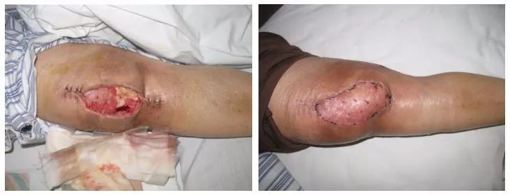 身上伤口不易愈合是怎么回事,身体后面有伤口一直不愈合