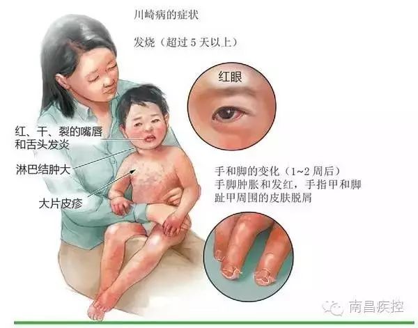 7个月宝宝连续高烧已超过72小时,什么病会导致儿童十多天连续发烧