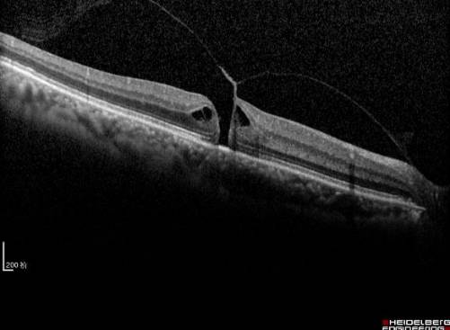 黄斑病变的克星,得了黄斑病变需要忌什么食物