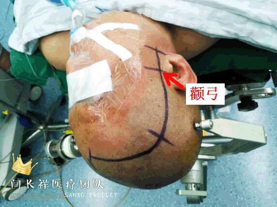 烦人的耳鸣,烦人耳鸣