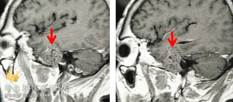 烦人的耳鸣,烦人耳鸣