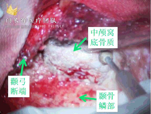 烦人的耳鸣,烦人耳鸣