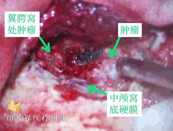 烦人的耳鸣,烦人耳鸣