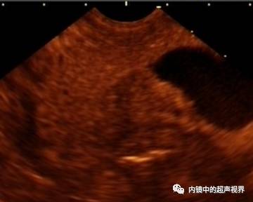 超声内镜美图攻略——动态范围与伪彩