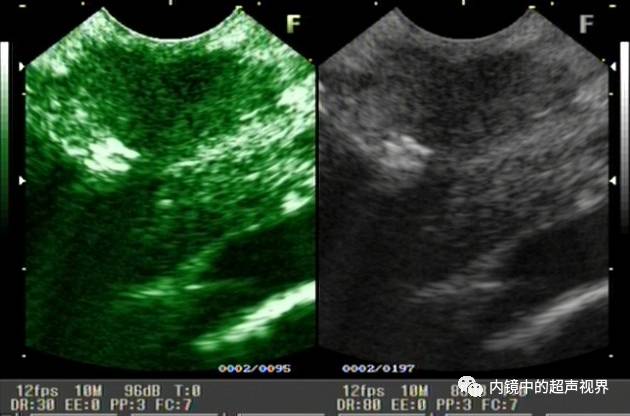 超声内镜美图攻略——动态范围与伪彩