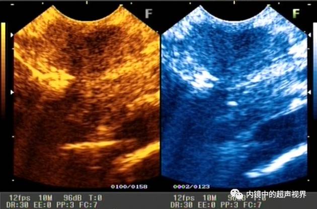 超声内镜美图攻略——动态范围与伪彩