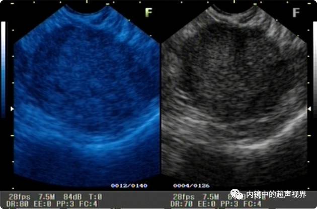 超声内镜美图攻略——动态范围与伪彩