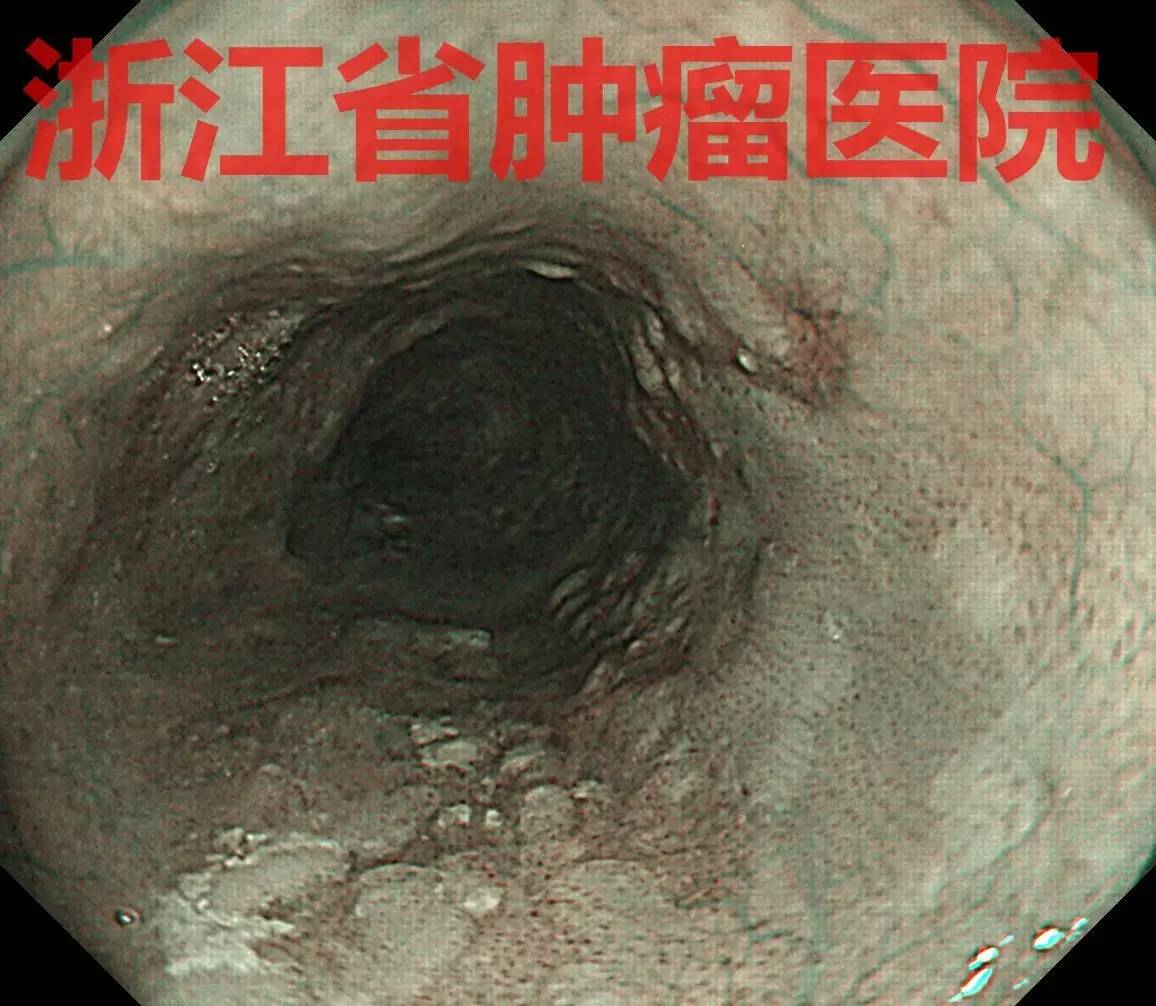 食管大面积黏膜病变，看看这家医院如何处理？！