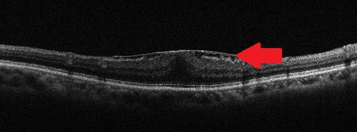 黄斑病变的克星,得了黄斑病变需要忌什么食物