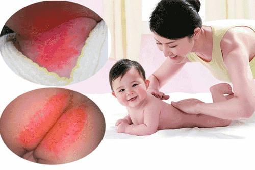 尿布疹跟妈妈的饮食有关吗,宝宝尿布疹有没有偏方治疗