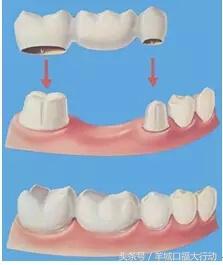 拔牙后可以直接镶牙吗,镶牙拔牙理论知识