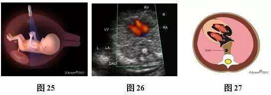 孕26周进行胎儿超声心动图检查,孕11-14周胎儿超声检测报告