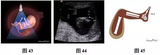 孕26周进行胎儿超声心动图检查,孕11-14周胎儿超声检测报告