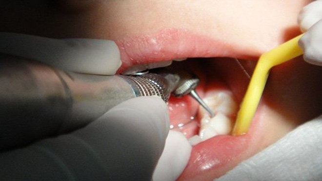 牙齿有大黑洞又痛怎么办,牙齿有黑洞很疼怎么办