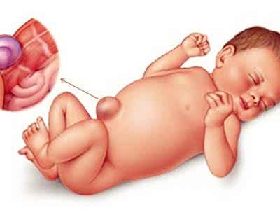 新生儿三凹是什么症状,新生儿脐疝怎么护理