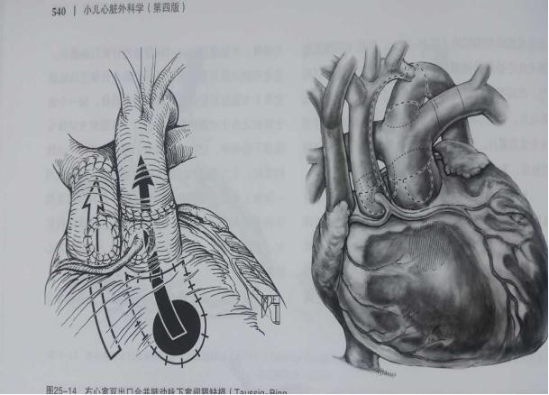 哈尔滨儿童医院能治先心病么,哈尔滨儿童医院做室缺手术