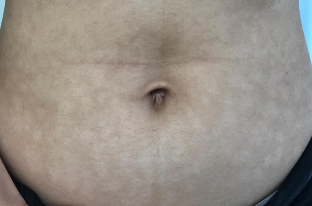 女生肚子上出现斑点,肚子上有一块白白的汗斑怎么治