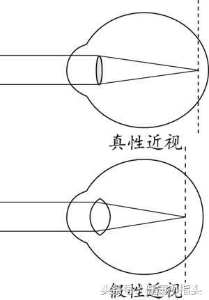 如何分辨近视眼是真性还是假性,假性近视怎么恢复正常的视力