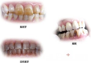 国外如何处理四环素牙,如何拯救四环素牙
