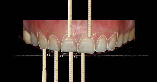国外如何处理四环素牙,如何拯救四环素牙