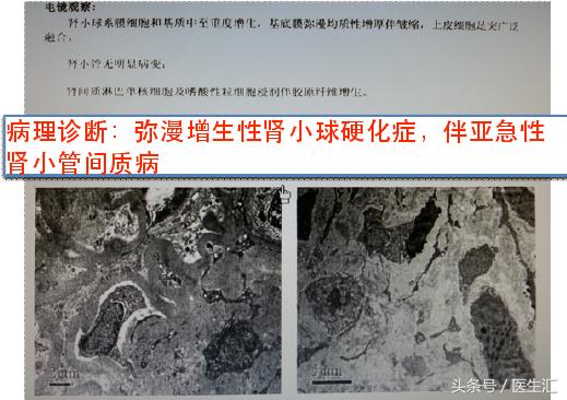 糖尿病酮症酸中毒病人伴有肾衰竭,糖尿病引起急性肾衰竭可以恢复吗