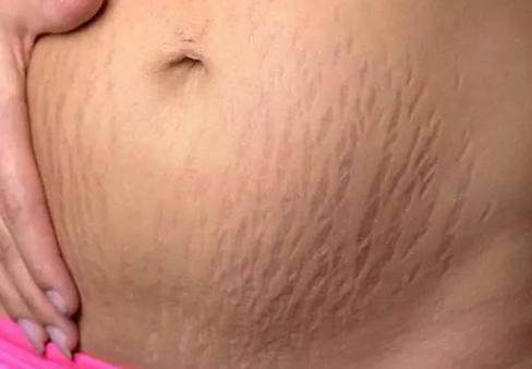 生了宝宝，你的“花肚皮”怎么办？可以这样做！