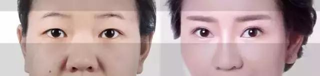 北京医院割双眼皮怎么样,北京三甲医院割双眼皮医生推荐