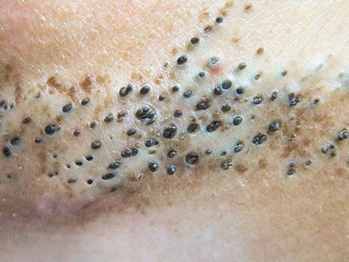 简单实用有效去黑头的方法,公认最有效的去黑头方法