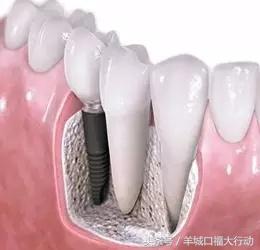 拔牙后可以直接镶牙吗,镶牙拔牙理论知识