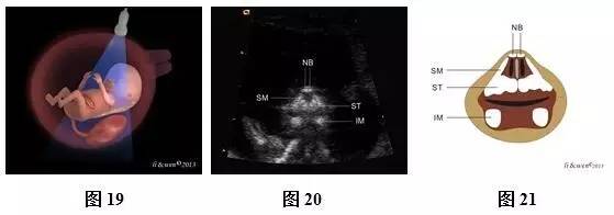孕26周进行胎儿超声心动图检查,孕11-14周胎儿超声检测报告