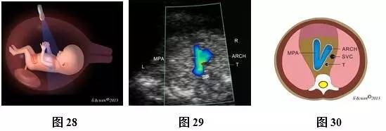 孕26周进行胎儿超声心动图检查,孕11-14周胎儿超声检测报告