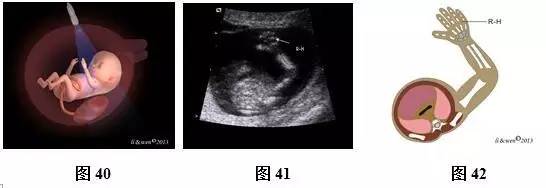 孕26周进行胎儿超声心动图检查,孕11-14周胎儿超声检测报告