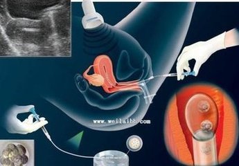 试管婴儿移植后出血,代表移植失败吗?