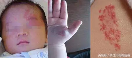 婴儿血管瘤对孩子有什么危害,宝宝血管瘤危害