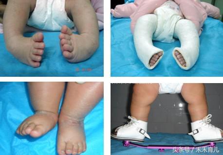 四维检查马蹄内翻有没有可能误诊,四维马蹄足和足内翻一样吗