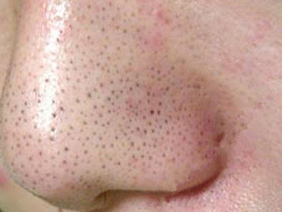 简单实用有效去黑头的方法,公认最有效的去黑头方法