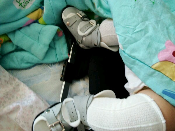 马蹄足内翻宝宝康复记，给相同经历的宝妈一些正能量