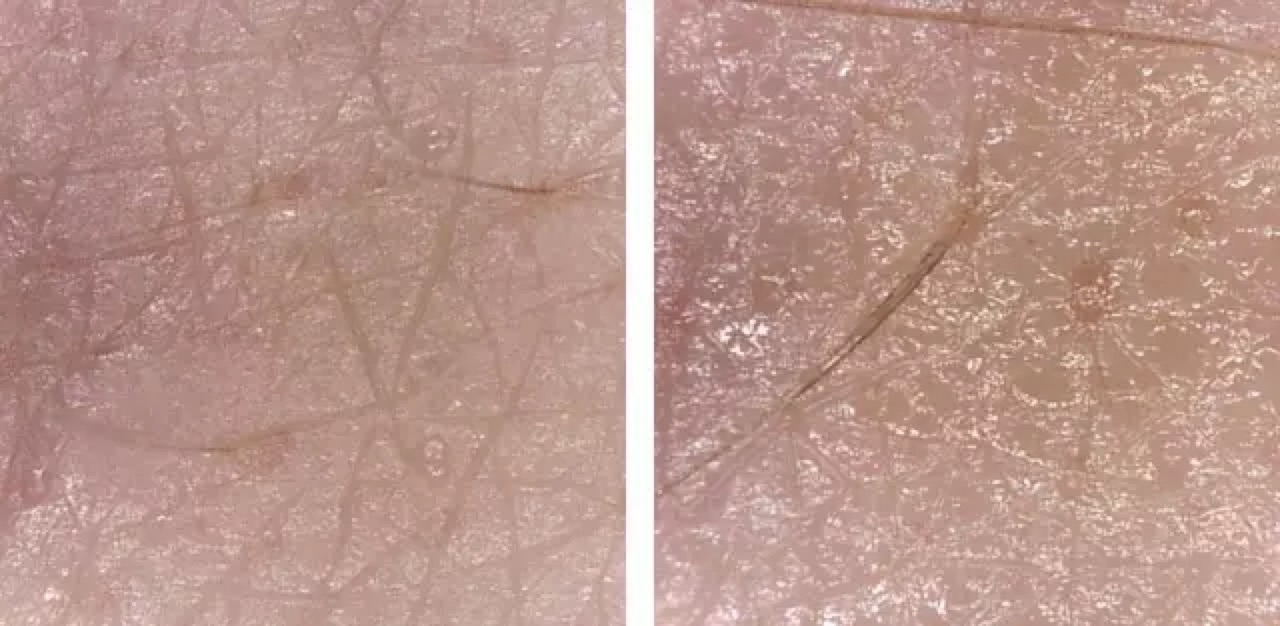 美容仪微整形图片,微整形注射美容仪