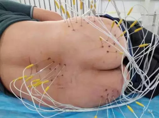 射频消融术和内热针有什么区别,内热针疗法治疗腰间盘突出