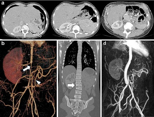 姜黄素抗癌研究报告,姜黄素能抗癌症吗
