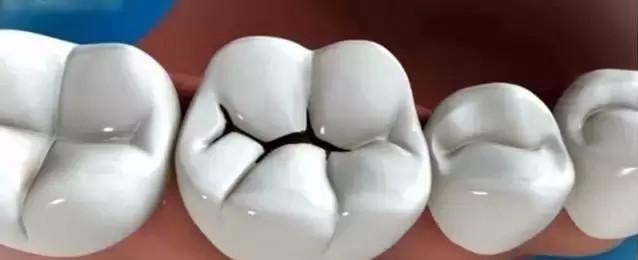 牙齿黑色污垢怎么去除有小窍门,牙齿黑色污垢怎么有效去除