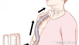 气切金属套管多久可以拔出,气切套管拔出后注意事项